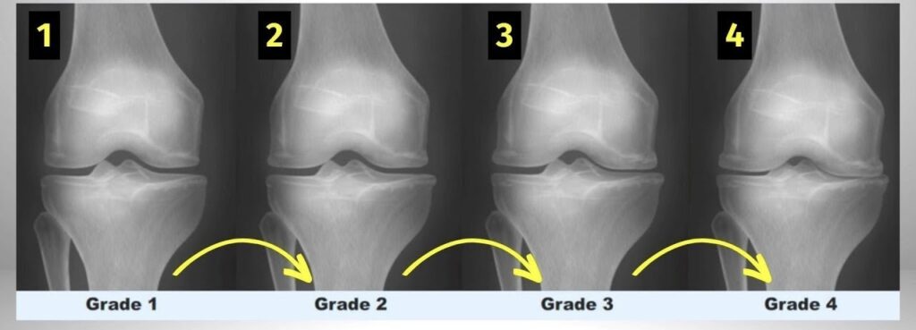 Rx joelho osteoartrite artrose 
